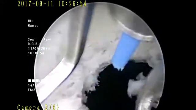 HoLEP смотреть онлайн
