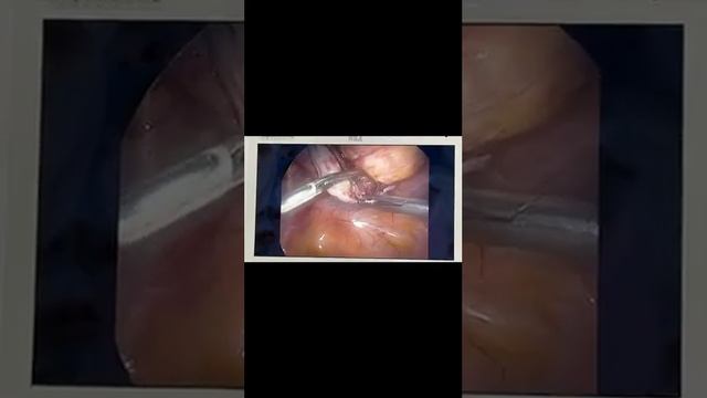 Дермоидная киста яичника смотреть онлайн