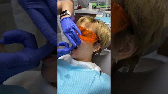 Примерка воскового полного съемного протеза. Часть 3 смотреть онлайн