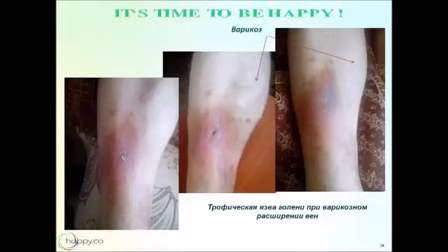 Результаты после применения орогранул HAPPY.CO смотреть онлайн