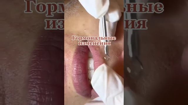 Чёрные точки на губах , причины ⬇️в описании смотреть онлайн