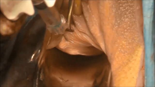 Аугментация точки G смотреть онлайн