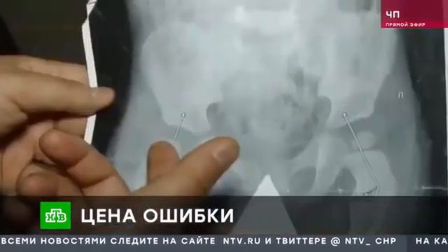 История о «лечении» и халатности анапских врачей показали по федеральному каналу смотреть онлайн