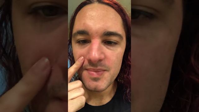 40% Mandelic Acid Peel Day 2