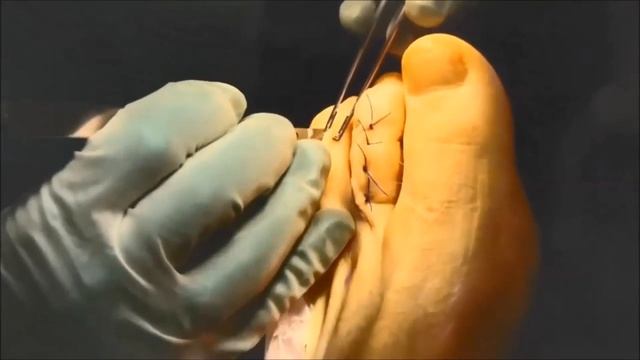 Hammertoe technique using Bioretec ActivaPin™ bioabsorbable pin смотреть онлайн