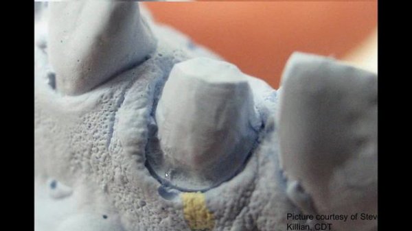 [Webinar] Reducing Remakes By Evaluating Impressions Prior To Pouring w/ Craig Pickett, CDT, RG, TE