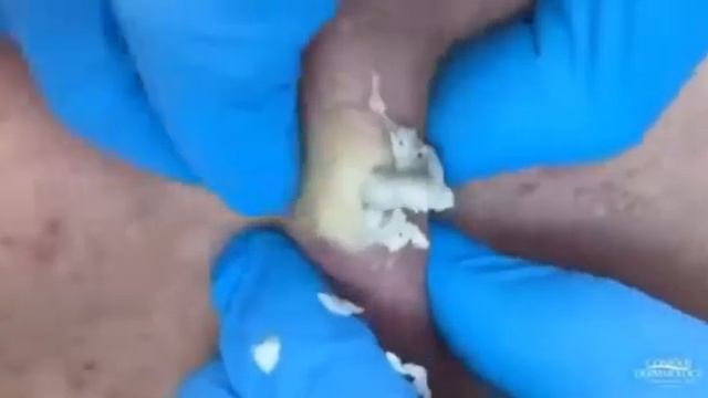 удаление нароста черной точки -Removing the build-up of a black point смотреть онлайн