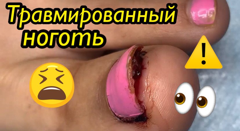 Травмированный ноготь ????⚠️ смотреть онлайн