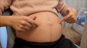 Уколы Клексан Беременность