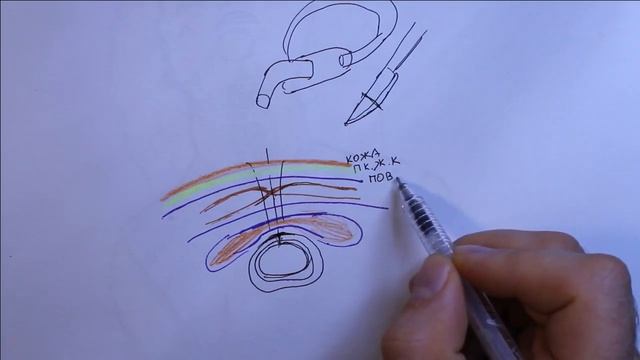 Трахеостомия трахеотомия