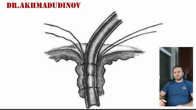 Гастростомия по Кадеру. Ахмадудинов А.М. смотреть онлайн