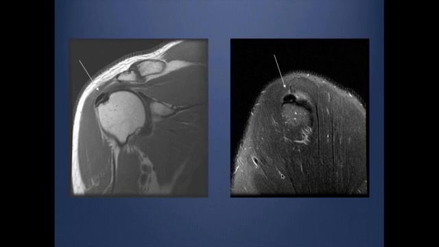MRI Shoulder part 4: Biceps, capsulitis смотреть онлайн