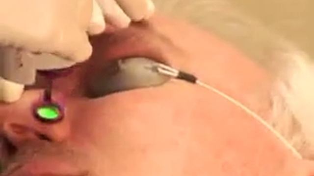 CANDELA VBeam 595 nm Pulsed Dye Lazer Sistemi смотреть онлайн
