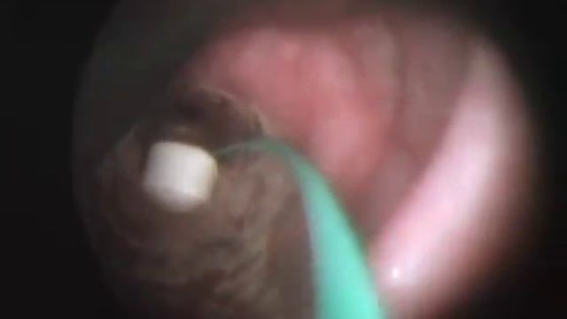 Foreign body bronchus ( Video 2 ) смотреть онлайн