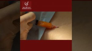 Липофилинг груди. Своего не отдам!