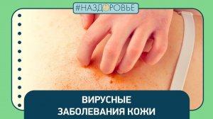 #НАЗДОРОВЬЕ: вирусные заболевания кожи