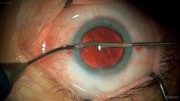 Oculentis Comfort EDOF Lukan Mishev Live Stream