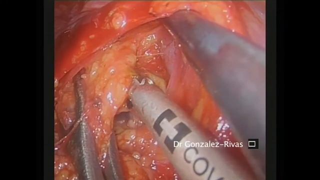 Asvide: Energy device for paratracheal lymph node dissection смотреть онлайн