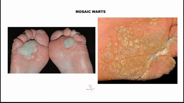 Viral infection -Skin смотреть онлайн