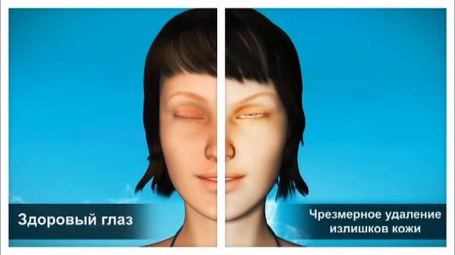 Блефаропластика - Blepharoplasty смотреть онлайн
