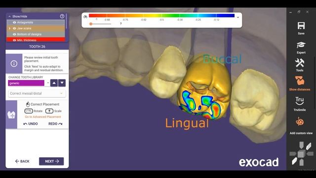 Inlay Tutorial Video with Exocad Software Very Easy смотреть онлайн