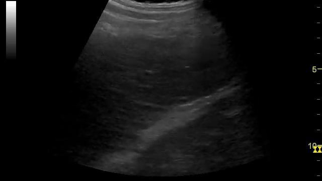 cirrhosis (long-term, Child A) цирроз печени смотреть онлайн