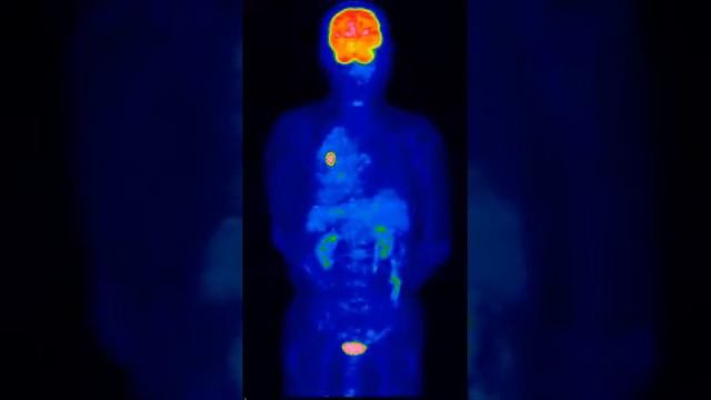 Ателектаз при опухолевом поражении смотреть онлайн