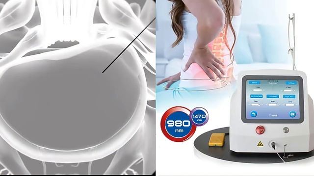 980/1470nm Diode Laser For Percutaneous Laser Disc Decompression смотреть онлайн