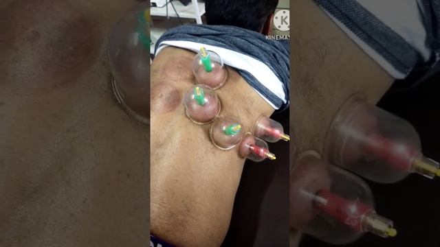 shoulder pain frozen shoulder & ribs pain #fitlifemoto #cupping_therapy смотреть онлайн