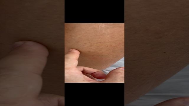 Варикоз. Добавочные вены. Как лечить варикоз? Флеболог Москва. Флеболог. Сосудистый хирург. смотреть онлайн