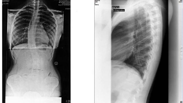 Корсет Шено - Reo® немецкой фирмы Regnier смотреть онлайн