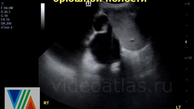Кистозная опухоль брюшной полости. смотреть онлайн