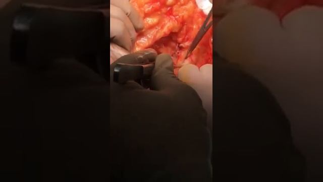 Sentinel lymph node biopsy from axilla in carcinoma breast смотреть онлайн