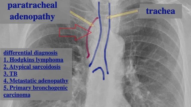 solitary paratracheal adenopathy on a chest radiograph смотреть онлайн