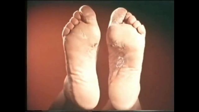 Zamburug'li (gribok) Kasalliklari Alomatlari ,tashxislash Davolash Va Oldini Olish!#грибок