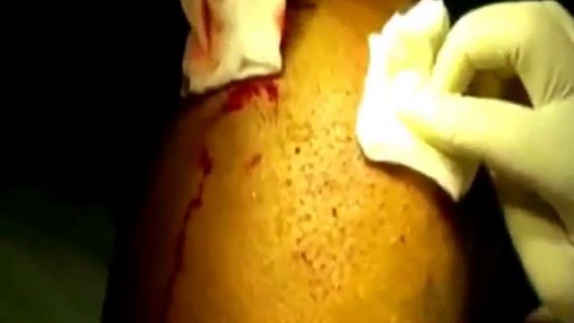 Hair Transplantation смотреть онлайн