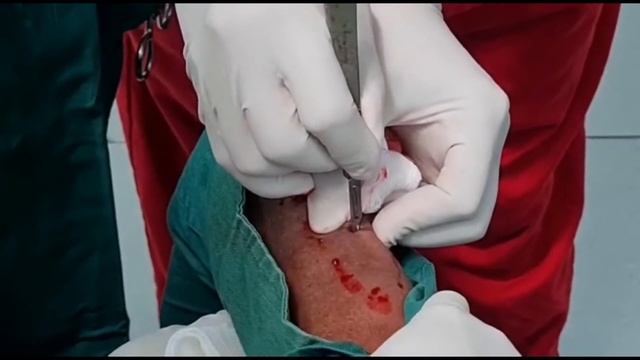Achilles Tendon Lengthening for Neuropathic Ulceration смотреть онлайн