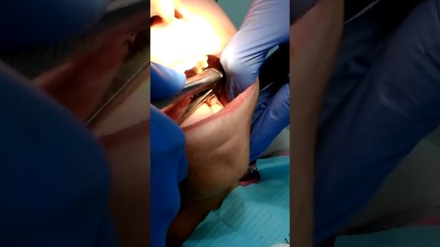 Удаление зуба мудрости на нижней челюсти смотреть онлайн