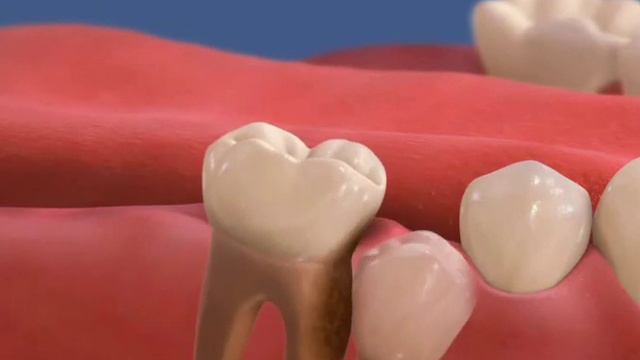 Орто Распорка для сохранения простраства после удаления смотреть онлайн