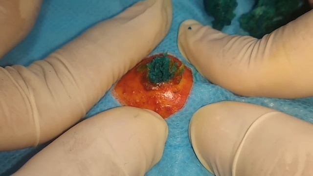 BEST Pimple Popping // Big Cystic Acne Blackheads // Whiteheads Removal  // Squeezing Pimples #026