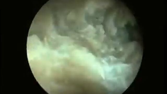 перкутанная нефролитотрипсия смотреть онлайн