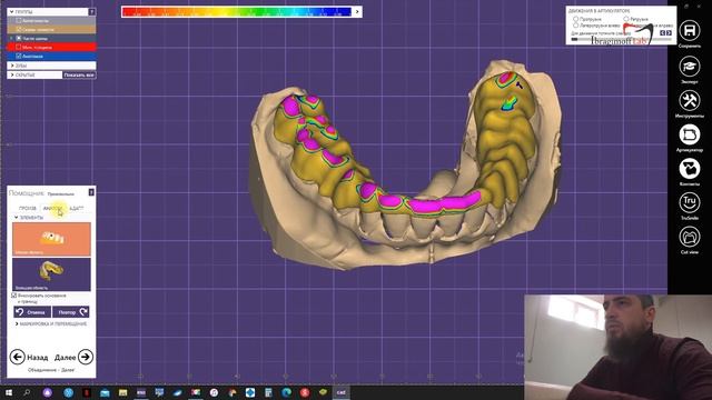 Изготовление окклюзионной шины в цс, параметры артикулятора. Латеротрузия, протрузия.