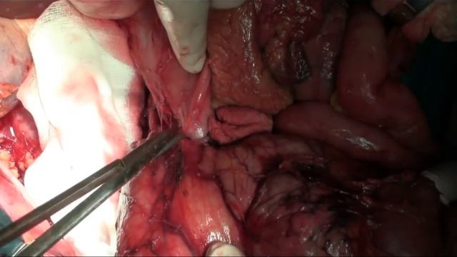 Ретро+перитонит русскиЙ