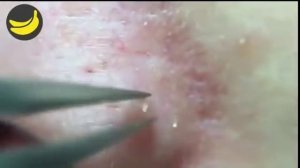 Удаление акне профессиональным острым пинцетом