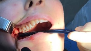 Удаление зуба мудрости на верхней челюсти