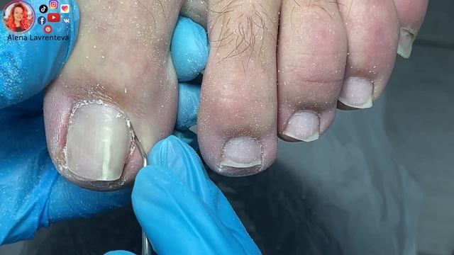 Скрученные ногти / Установка титановой нити смотреть онлайн