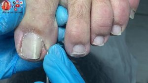 Скрученные ногти / Установка титановой нити