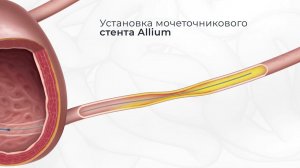 Установка мочеточникового стента Allium