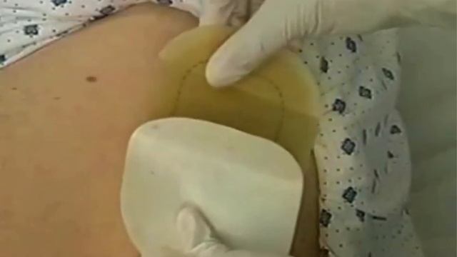 Wound Debridement Methods & Techniques | Wound Healing | WoundEducators.com смотреть онлайн