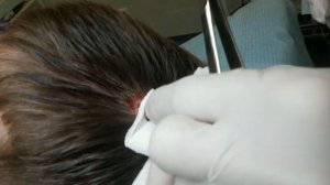 Удаление жировика на голове с экономным сбриванием волос